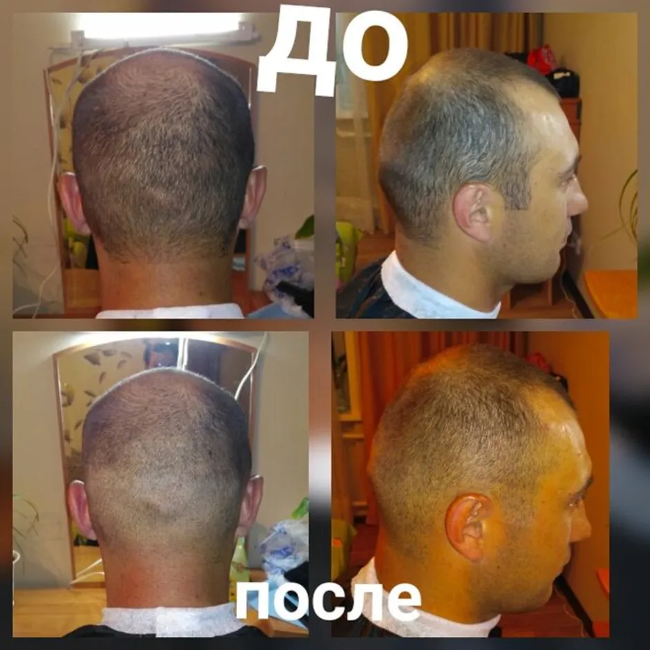 После пересадки волос