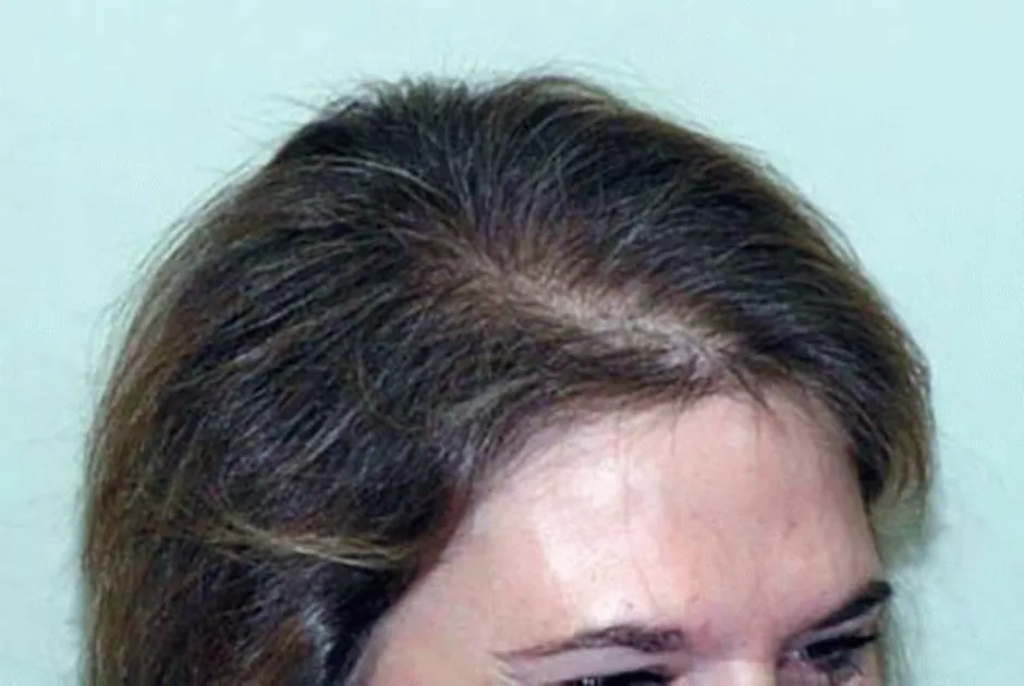 Женская алопеция