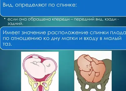 Косое предлежание плода фото