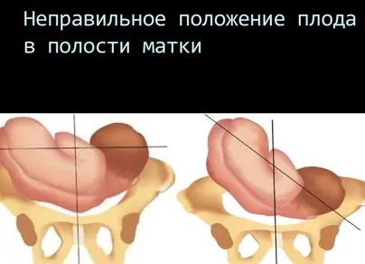 Косое предлежание плода фото