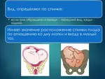 Косое Предлежание Плода Фото